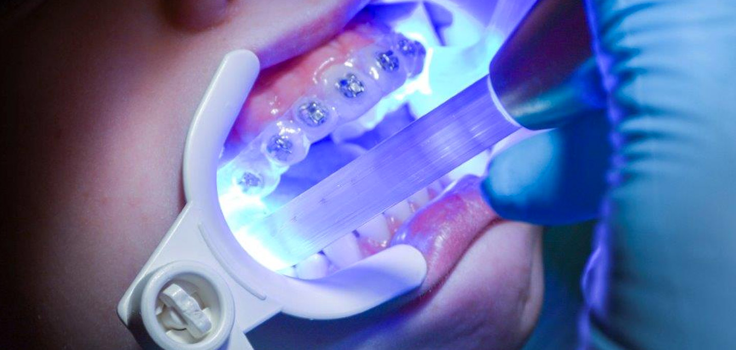 Indirect bonding - JJ Thompson Orthodontic Appliances