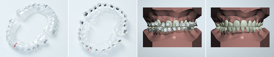 Indirect bonding - JJ Thompson Orthodontic Appliances